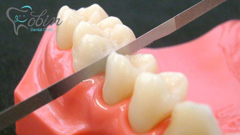 ارتودنسی و استریپ دندان